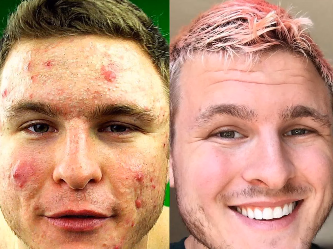 Can a 30-day acne-free diet help clear skin?