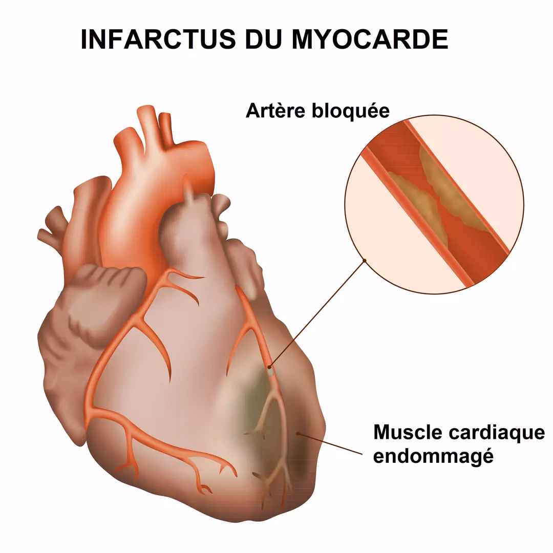 Comment mettre à jour sa situation après un arrêt cardiaque ?