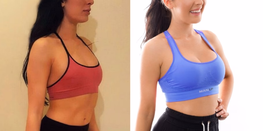 Why do athletes choose submuscular implants?