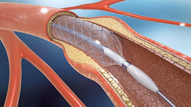 What is a PCI angioplasty?