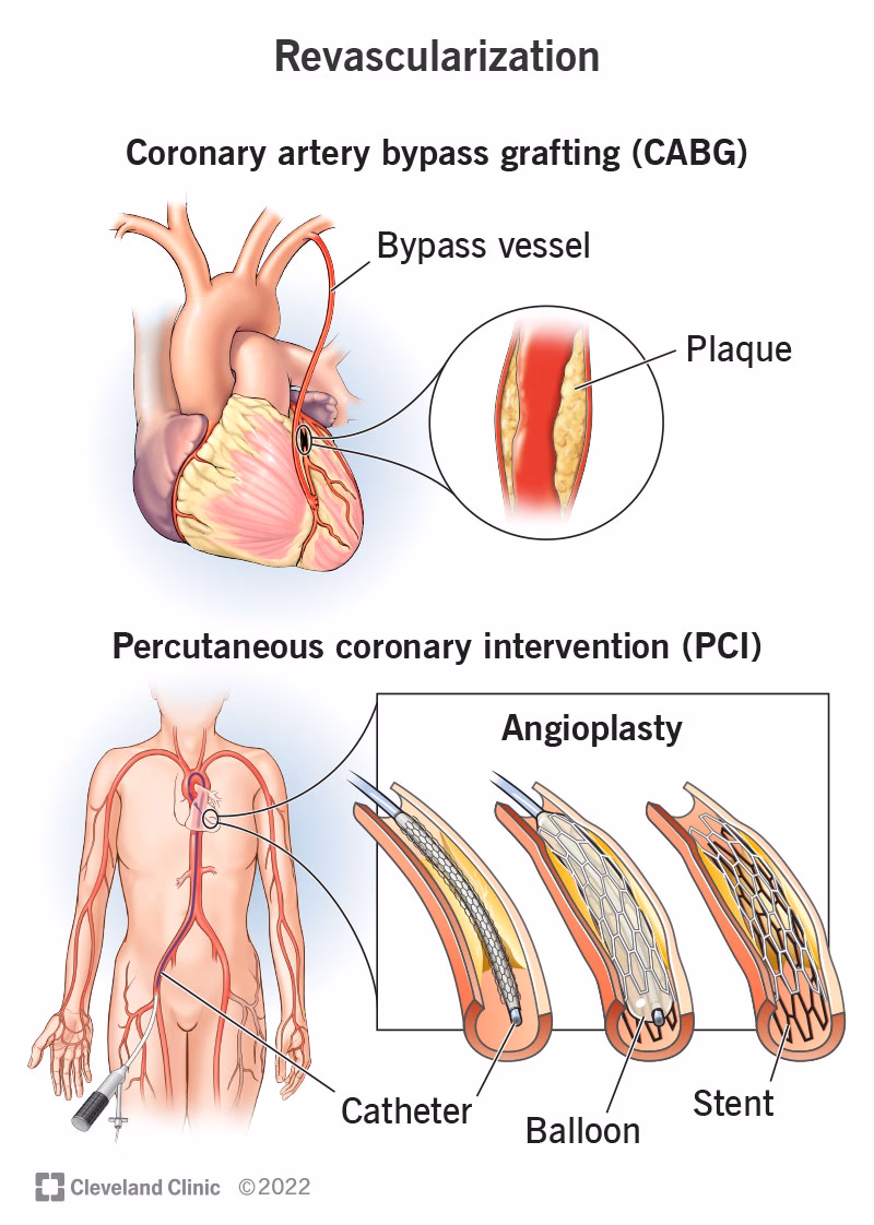 Do I need a PCI if I have a fatty artery?