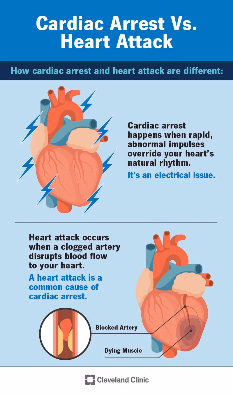 What is cardiopulmonary arrest?
