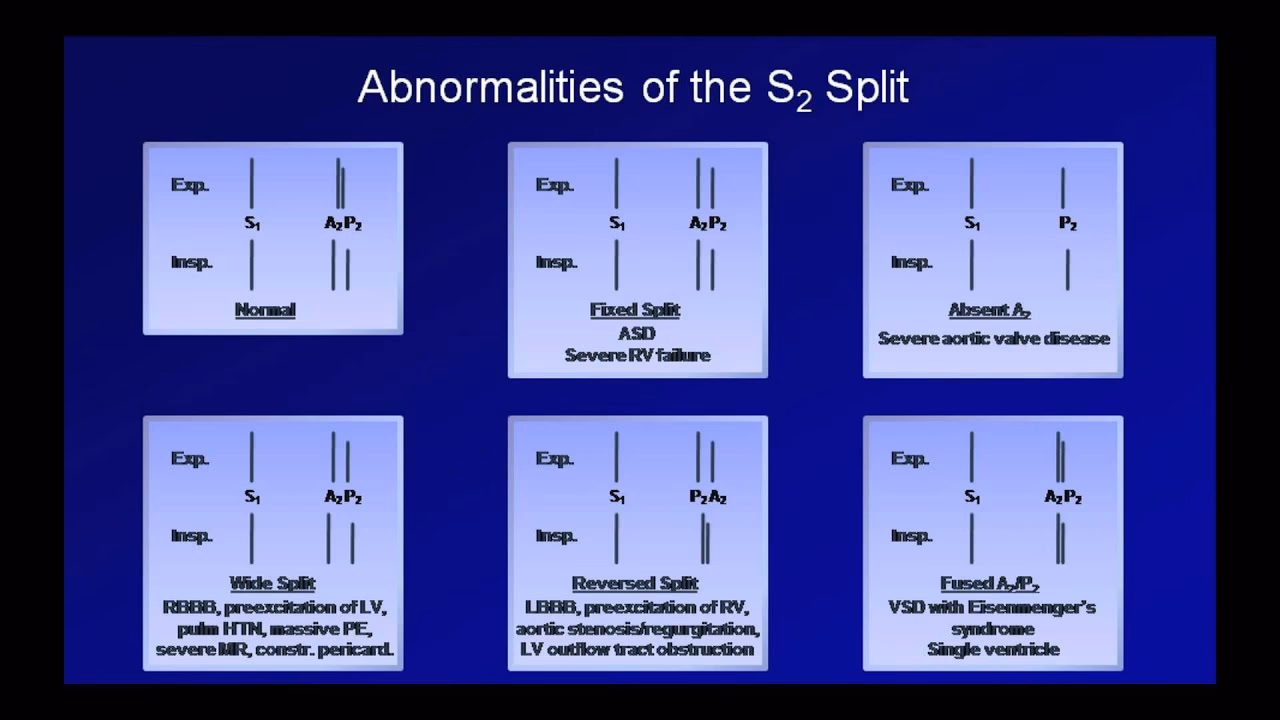 What does a heart beat sound like in a stethoscope?
