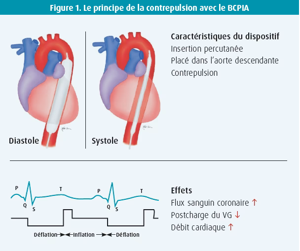 Qu'est-ce que le choc cardiogénique ?