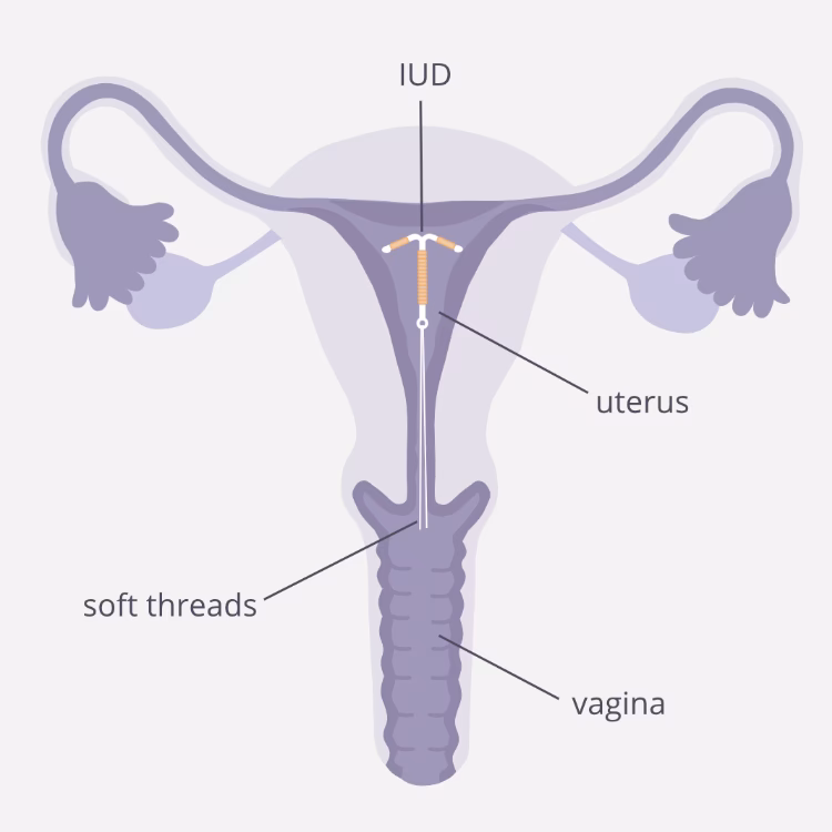 How does a coil fitting procedure work?