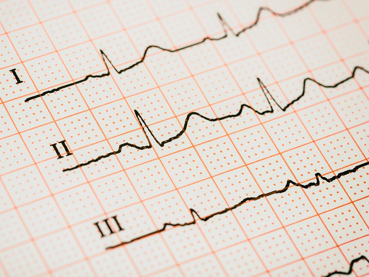 What is a point of care ECG course?