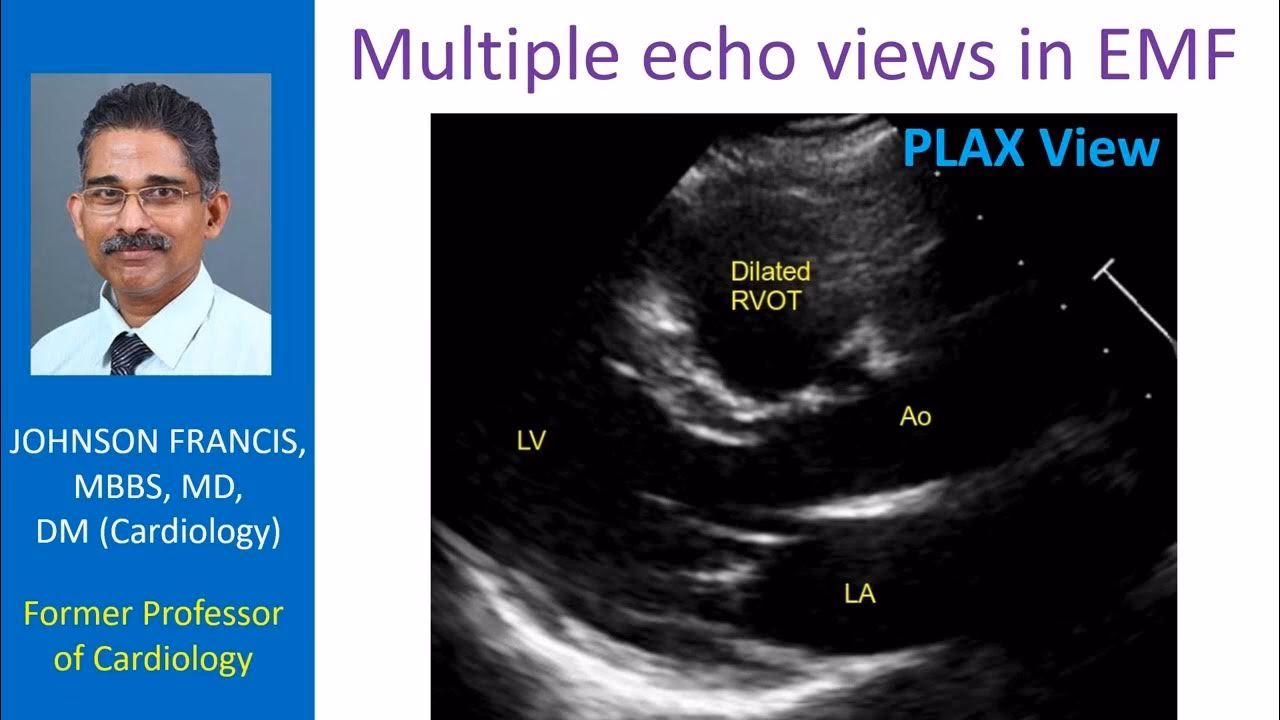Is EMF exposure a risk factor for cardiovascular complications?