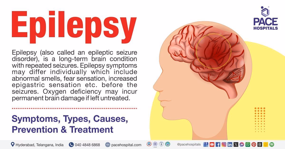 What is an epileptic seizure?