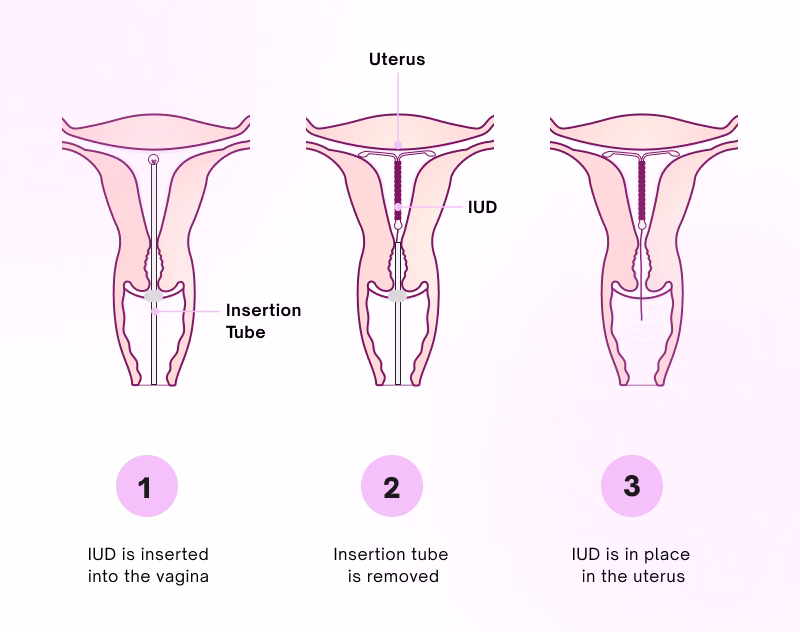 What should I do before a coil fitting appointment?