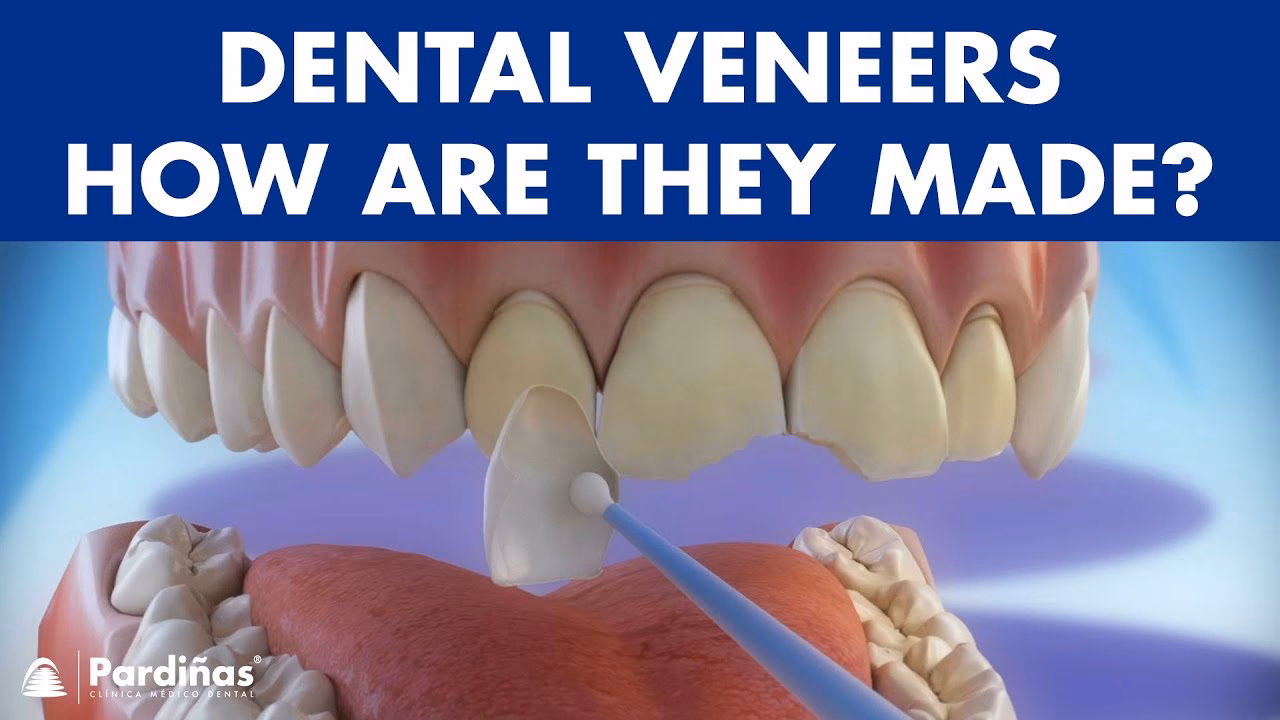 How are dental veneers made?