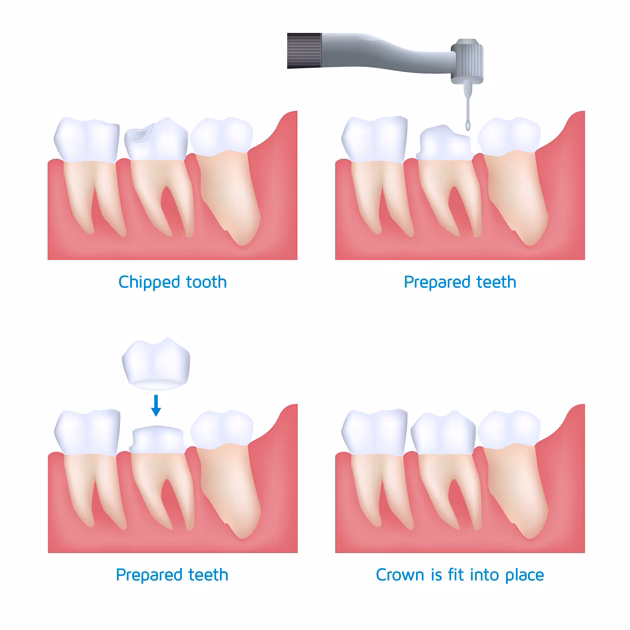 What does a dental crown look like?