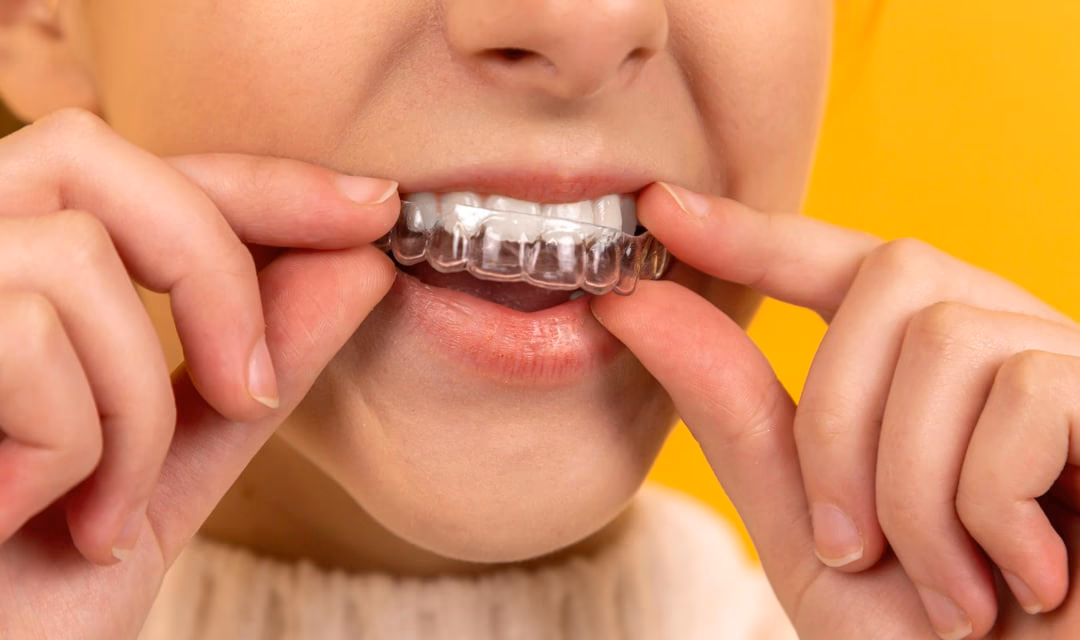 How do you tighten a dental retainer?