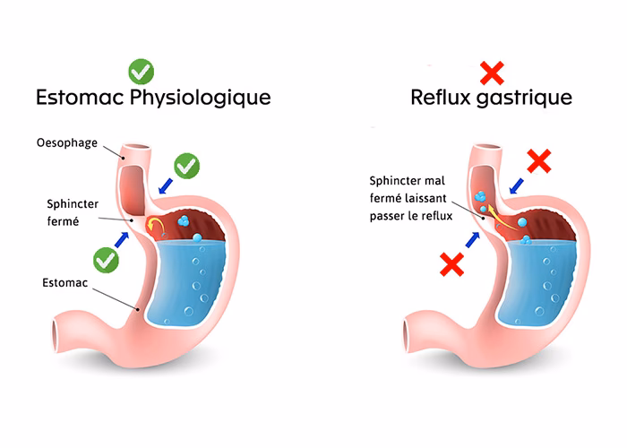 Qu'est-ce que la malposition cardio-tubérositaire?