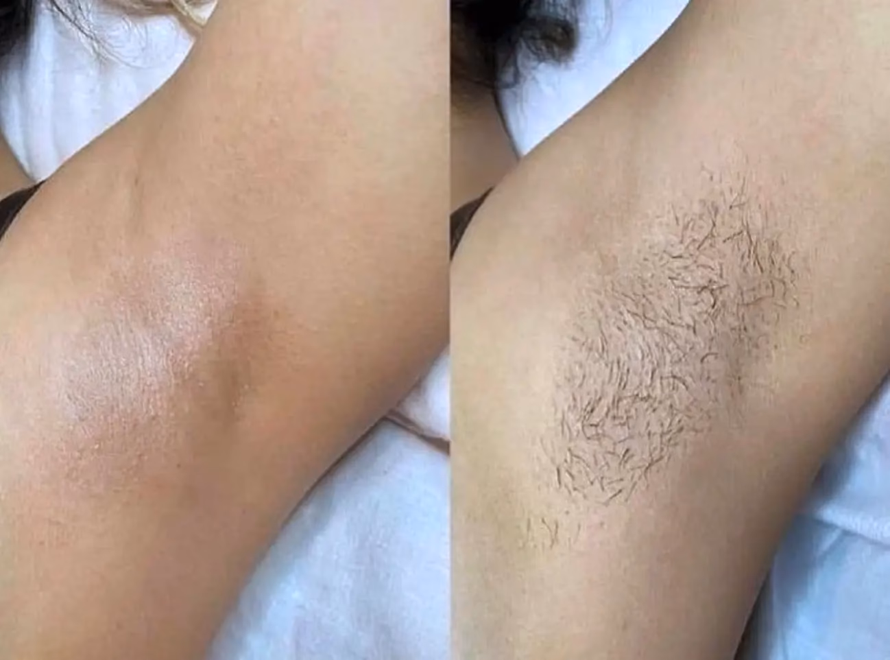 Is laser surgery a good career choice in Australia?