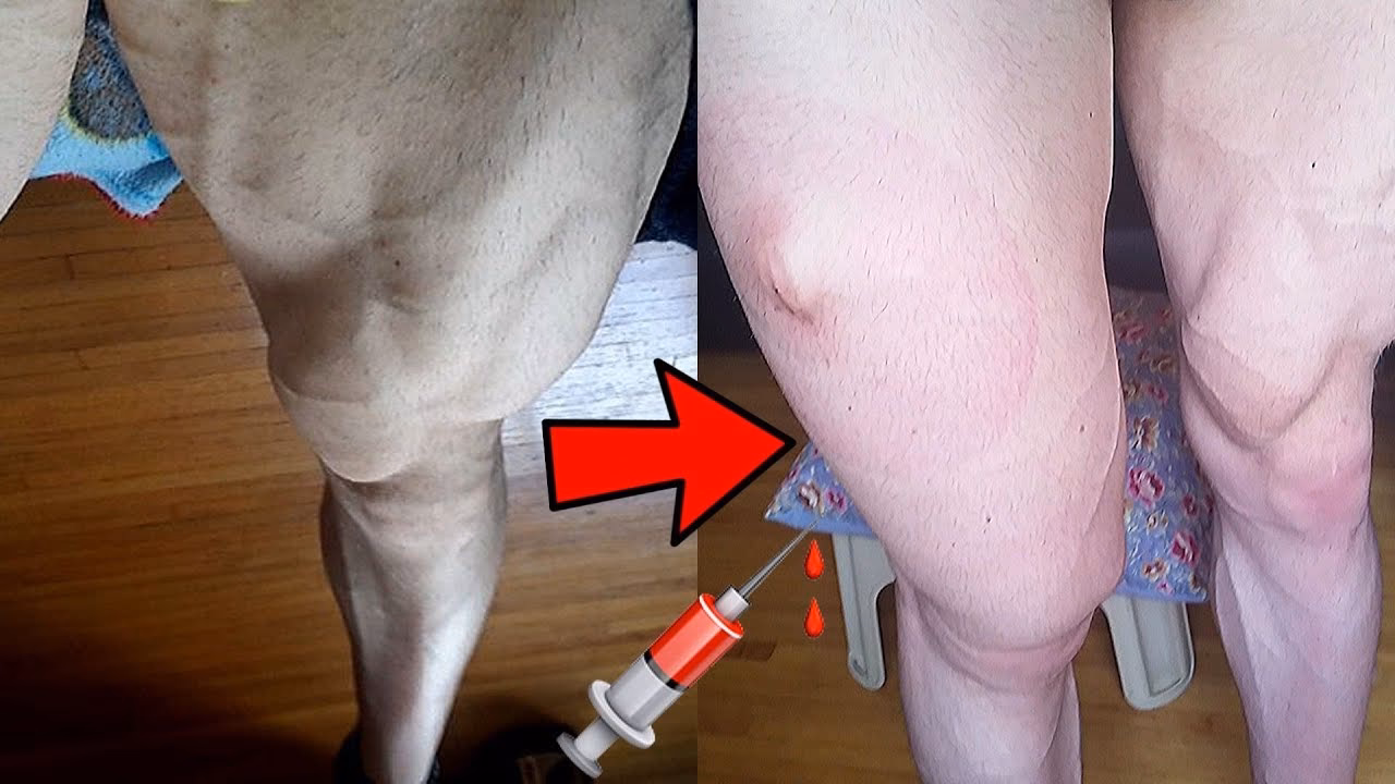 Where should I get a fat injection?