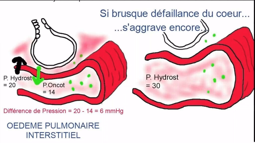 Comment fonctionne un OAP cardiogénique ?