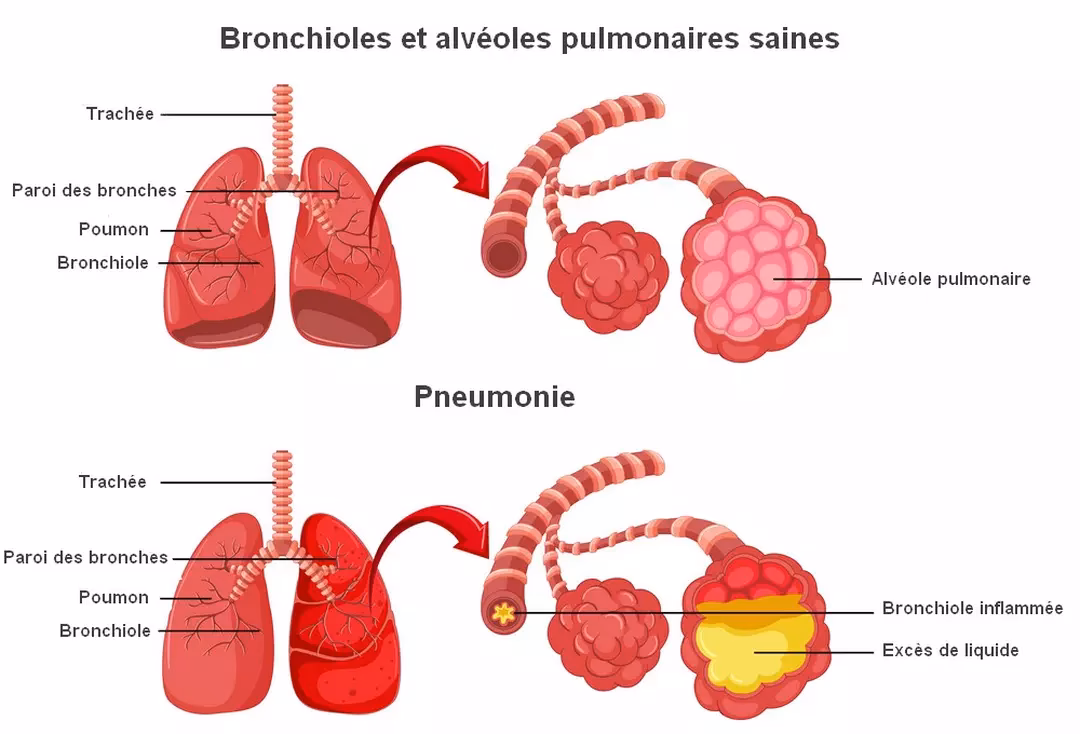 Pourquoi les pneumonies sont-elles dangereuses pour la santé cardiaque ?