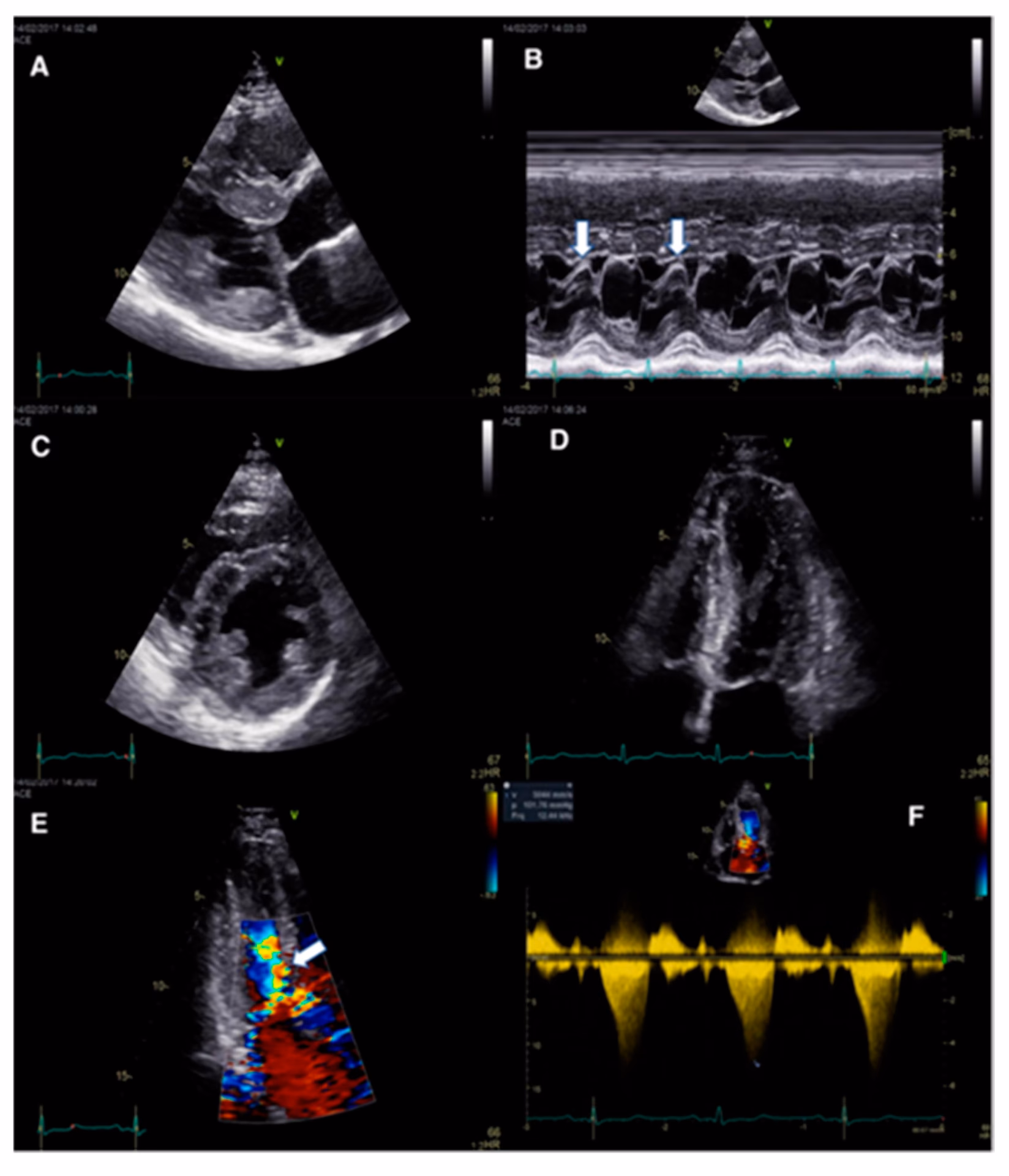 Can transthoracic echocardiography identify secundum ASD?