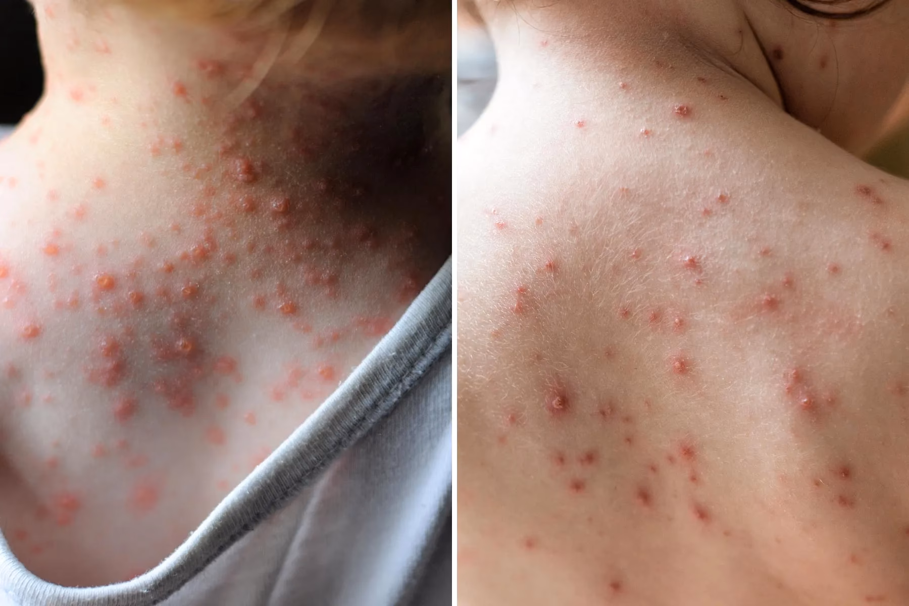 Are VZV patients at risk for cardiovascular disease?