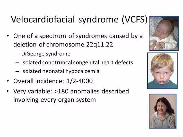 What is velocardiofacial syndrome?