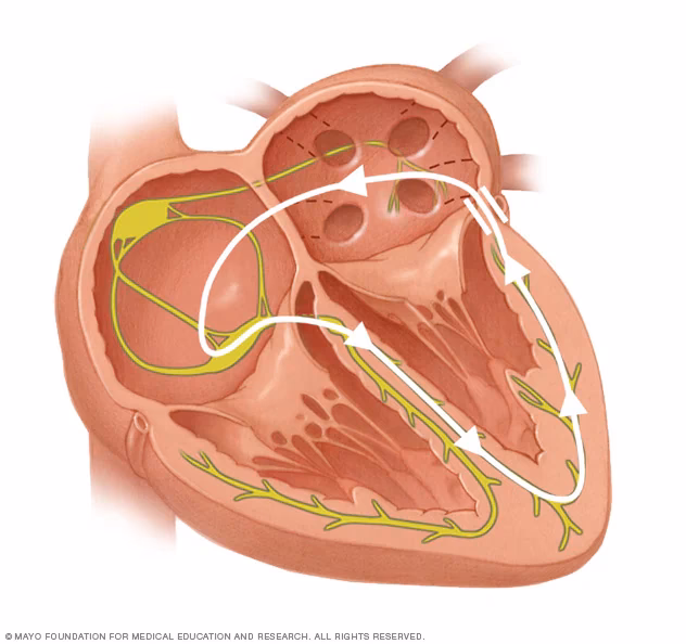 What causes a premature ventricular contraction (PVC)?