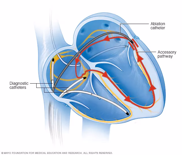 What is the treatment for ventricular arrhythmias (VPBS)?